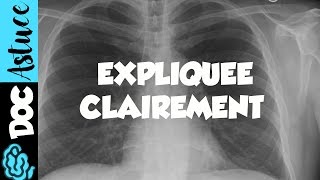 🔴 Dr Astuce  3 ANOMALIES RADIO THORAX EXPLIQUÉES CLAIREMENT  PARTIE 1 [upl. by Annaya]