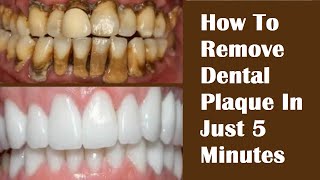 How To Remove Dental Plaque In Just 5 Minutes  Remove Tartar On Teeth FAST HealthyPunchToday [upl. by Rexferd200]