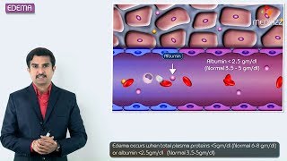 1Edema introduction  Hemodynamic pathology Fmge Neet PG and usmle [upl. by Silvester]