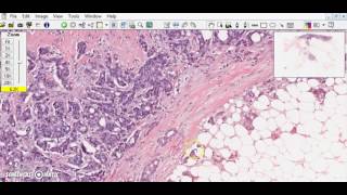 Breast ductal carcinoma Breast cancer [upl. by Bobbee620]