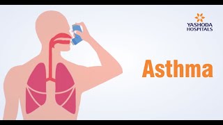 Asthma Symptoms amp Precautions amp Causes Bronchial Thermoplasty [upl. by Lester857]