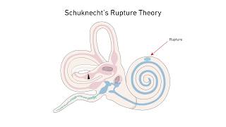 Menieres Disease A New Theory [upl. by Laefar990]