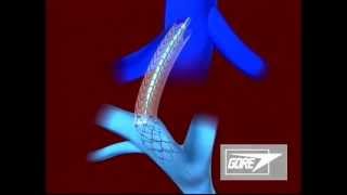 Endoprosthesis  Transjugular Intrahepatic Portosystemic Shunt TIPS [upl. by Ellenej]