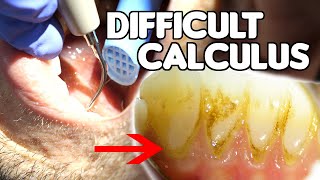 How To Remove Difficult amp Tenacious Calculus Tartar [upl. by Noraj]