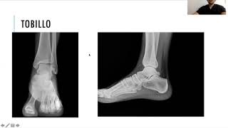 Radiología simple de miembro inferior [upl. by Airetahs29]