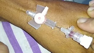 Intravenous Cannulation Technique  Iv Cannulation Procedure [upl. by Biggs678]