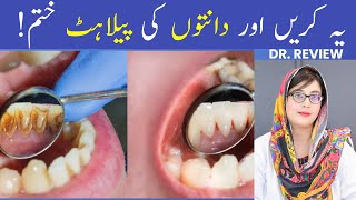 The 1 Top Remedy for Dental Plaque TARTAR [upl. by Neelehtak153]