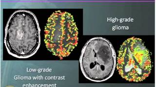 ADC Positive Multiple Sclerosis  Demyelination MRI Case Review [upl. by Haroved]