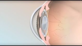 MLF syndrome  Internuclear Ophthalmoplegia MADE EASY [upl. by Deaner]