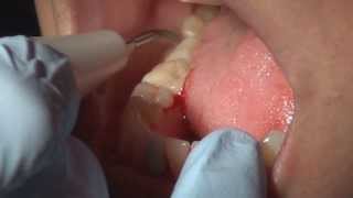 How to do Full Mouth Debridement [upl. by Rehpotsrihc]