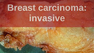 Breast Carcinoma Invasive  Pathology mini tutorial [upl. by Nalahs]