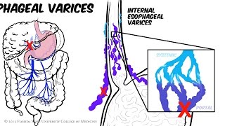 Portal Hypertension Animated Review [upl. by Evad]