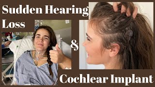 10 Step Guide to Getting a Cochlear Implant [upl. by Leik194]