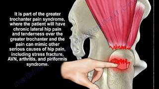 Gluteus Medius Tendon Tear  Everything You Need To Know  Dr Nabil Ebraheim [upl. by Annaliese]