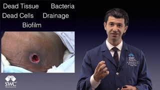 Debridement Myths for Youtube Video [upl. by Sula]