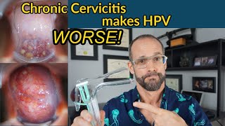 HPV combined with chronic cervicitis increases the risk of severe dysplasia and cervical cancer [upl. by Virgin]