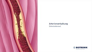 Arterienverkalkung Arteriosklerose und Angiografie [upl. by Lynch]