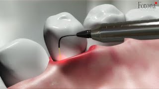 TwinLight® Periodontal Treatment [upl. by Frederigo]