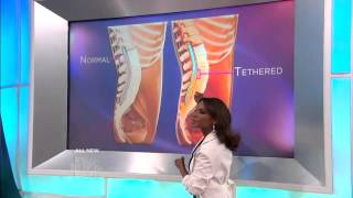 Tethered Cord Syndrome Explained Medical Course [upl. by Durnan]