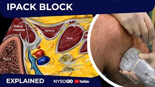 IPACK Block  Regional anesthesia Crash course with Dr Hadzic [upl. by Schug]