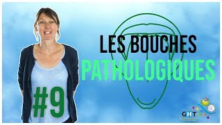 Les Bouches Pathologiques  9  Formation Hygiène BuccoDentaire [upl. by Airda]