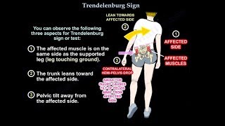 Trendelenburg Sign  Everything You Need To Know  Dr Nabil Ebraheim [upl. by Kinch824]