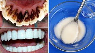 How To Whiten Teeth In 2 Minutes  Removes Tartar And Black Teeth Without Dentist [upl. by Swenson]