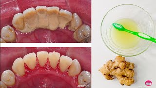 How to Remove Tartar from Teeth at home naturally  Natural Ways to Remove Tartar Buildup [upl. by Anesuza961]