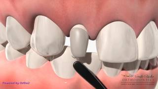 Orthodontic Treatment  Peg Lateral Composite Buildup VS Veneer [upl. by Aivatco]