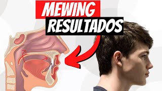 MEWING Resultados  ¿CUÁNTO TARDA [upl. by Amathiste]