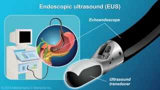 Understanding EUSFNA [upl. by Hellene927]