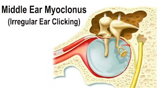 Middle Ear Myoclonus  Irregular Clicking Sound in the Ear [upl. by Adelric427]