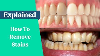 How to remove stains from the teeth [upl. by Outhe]