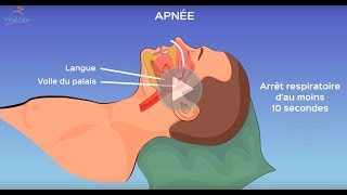 L’apnée du sommeil qu’estce que c’est [upl. by Pich]