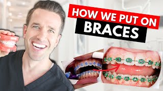 How Braces are Put On  Part IV Dr Nate [upl. by Iva]