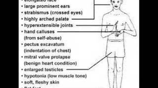 Fragile X Syndrome [upl. by Danette]