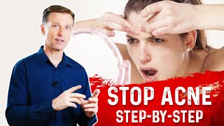 How To Get Rid Of Acne Eliminate Acne Permanently – DrBerg [upl. by Kciremed]