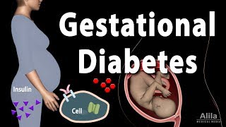 Gestational Diabetes Animation [upl. by Aekahs]