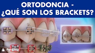 Ortodoncia – Brackets y otras partes del aparato dental © [upl. by Boeschen]