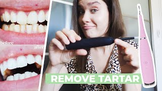 HOW TO REMOVE CALCULUS TARTAR PLAQUE AT HOME  Ultrasonic Tooth Cleaner Review  Does It Work [upl. by Herrera]