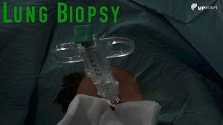 Lung biopsy [upl. by Nananne204]