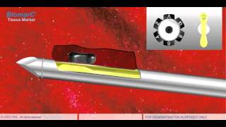 STEREOTACTIC VACUUM BIOPSY VAB [upl. by Acirred]