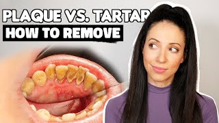 Plaque vs Tartar  How To Remove Plaque From Teeth [upl. by Odel]