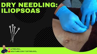 Dry Needling Iliopsoas [upl. by Oric]