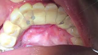 Houston Cosmetic DentistWorst Tartar I have seen Watch how we remove it [upl. by Eenafit]