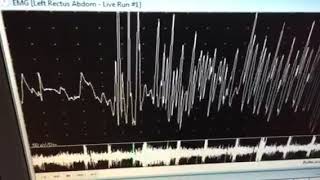 neuromyotonic discharges [upl. by Nollaf]