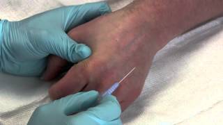 Intravenous Catheter Placement [upl. by Barcellona]