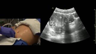 Transabdominal Pelvis Ultrasound Scanning Techniques [upl. by Kellda479]