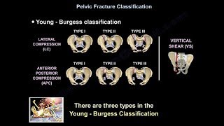 Pelvic Fractures  Everything You Need To Know  Dr Nabil Ebraheim [upl. by Tansey622]