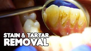 Dental Cleaning EXPLAINED  Stain amp Tartar Removal [upl. by Revorg236]